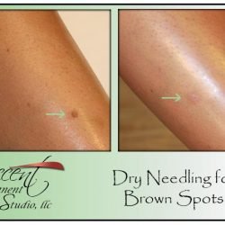 Dry Needling