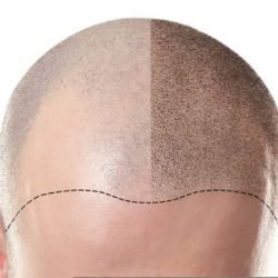 SMP Treatment